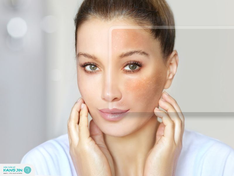 cách chăm sóc da bị nám