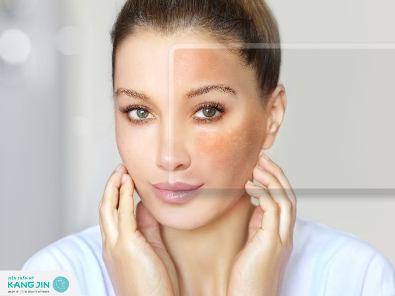 Điều trị giảm sắc tố da bằng biện pháp nào?