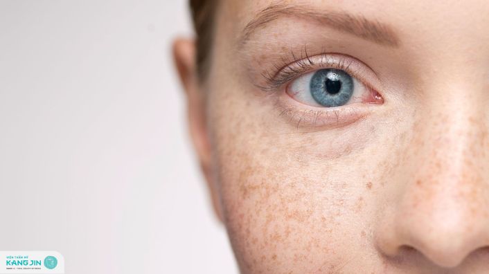 cách làm hết tàn nhang ở tuổi dậy thì