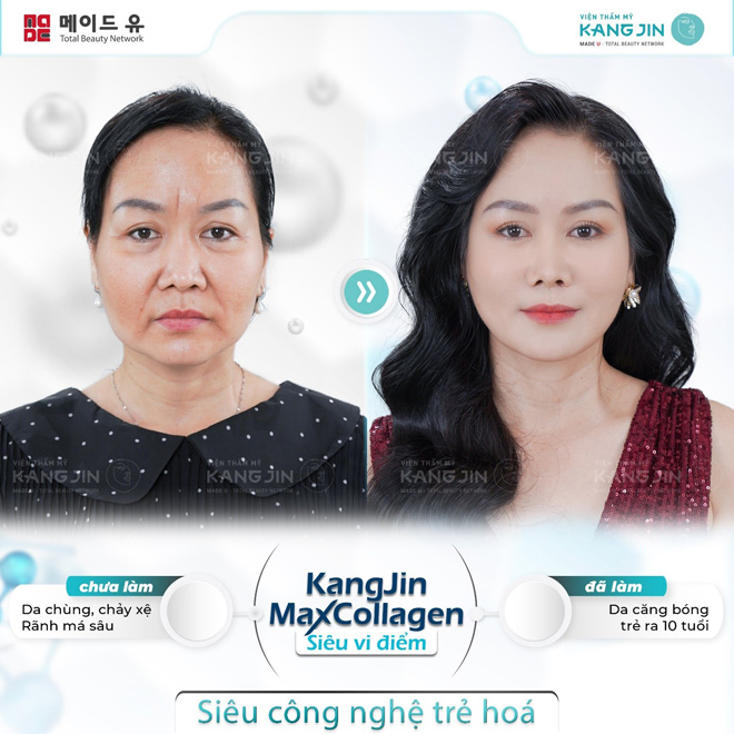 căng da mặt bằng công nghệ cao 