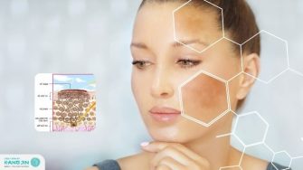 Cấu trúc da nám: Hiểu rõ để có phương pháp điều trị hiệu quả