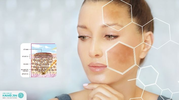 Cấu trúc da nám: Hiểu rõ để có phương pháp điều trị hiệu quả