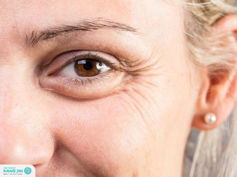 có phải da nhờn sẽ ít nếp nhăn hơn