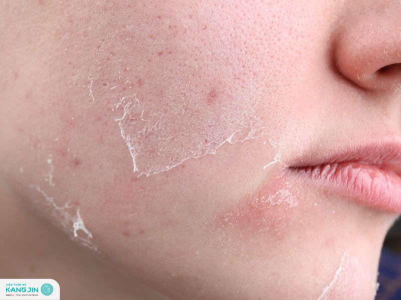 da mặt bị khô bong tróc phải làm sao