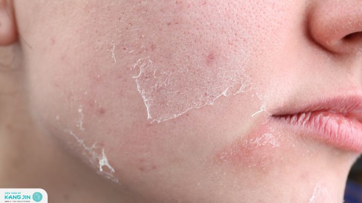 da mặt bị khô bong tróc phải làm sao