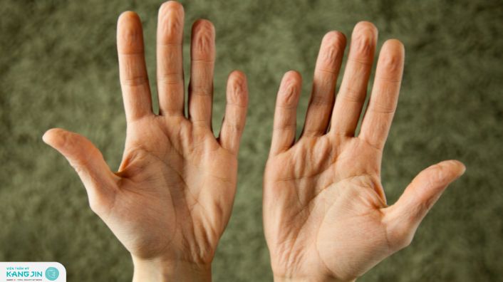 da tay nhăn nheo thiếu chất gì