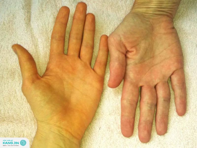 da vàng thiếu chất gì