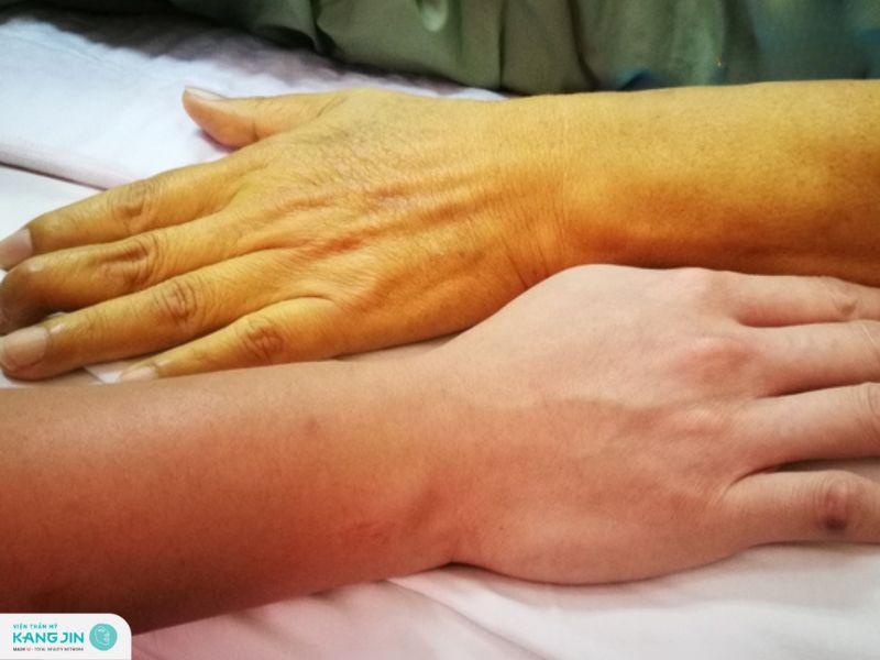 da vàng thiếu chất gì