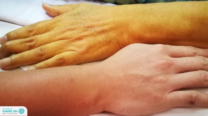 da vàng thiếu chất gì