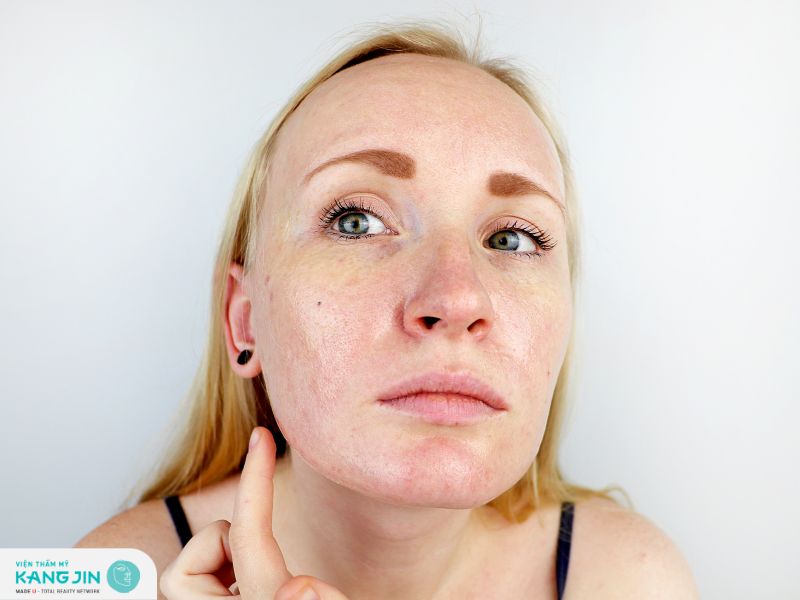 Giảm sắc tố da khi cơ thể bị sụt một lượng melanin đáng kể