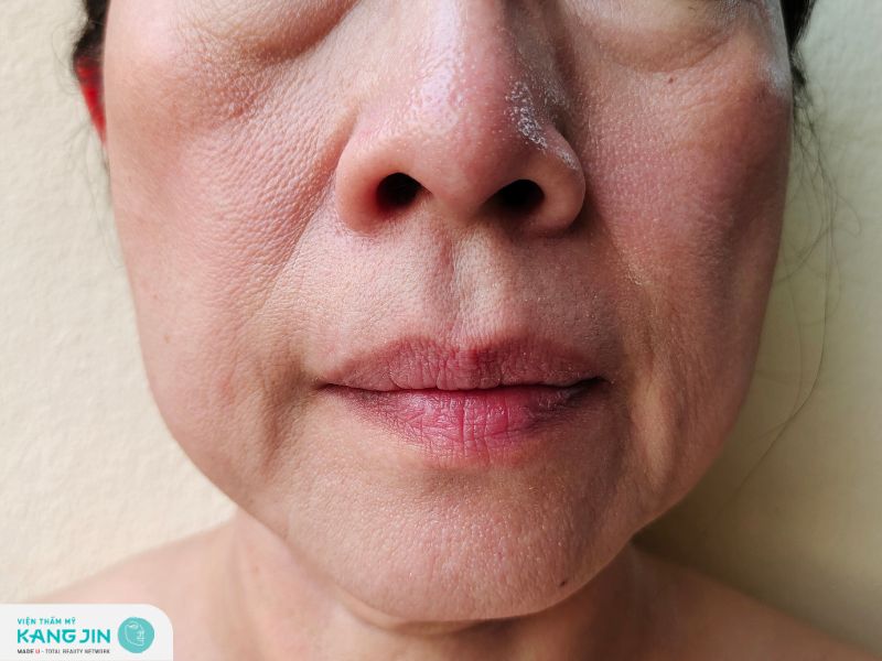 Da mặt chảy xệ có những biểu hiện nào?