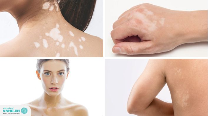 Đốm trắng trên da dấu hiệu cảnh báo bệnh gì? Cách điều trị
