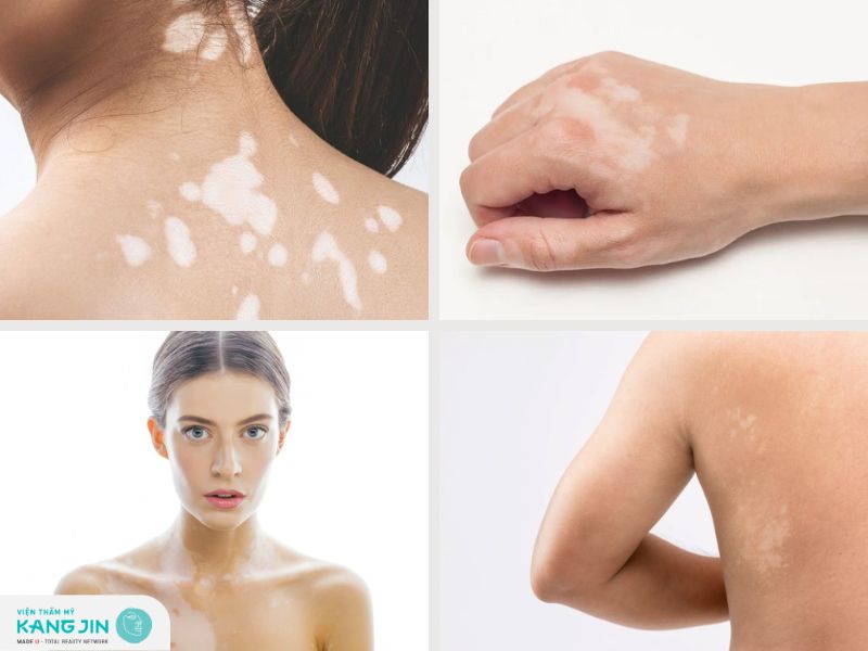 Xuất hiện đốm trắng trên da là cảnh báo bệnh gì? Cách điều trị như nào hiệu quả?