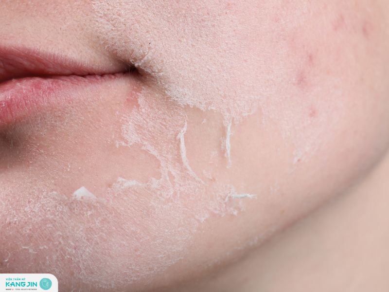 hiện tượng sau khi peel da