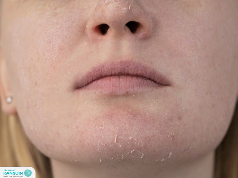 hiện tượng sau khi peel da