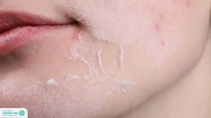 hiện tượng sau khi peel da