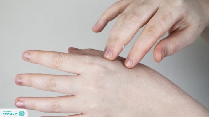 lột da tay là thiếu chất gì