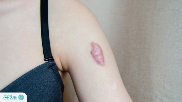 Bỏ túi ngay 6 mẹo chữa sẹo lồi dân gian cực đơn giản tại nhà