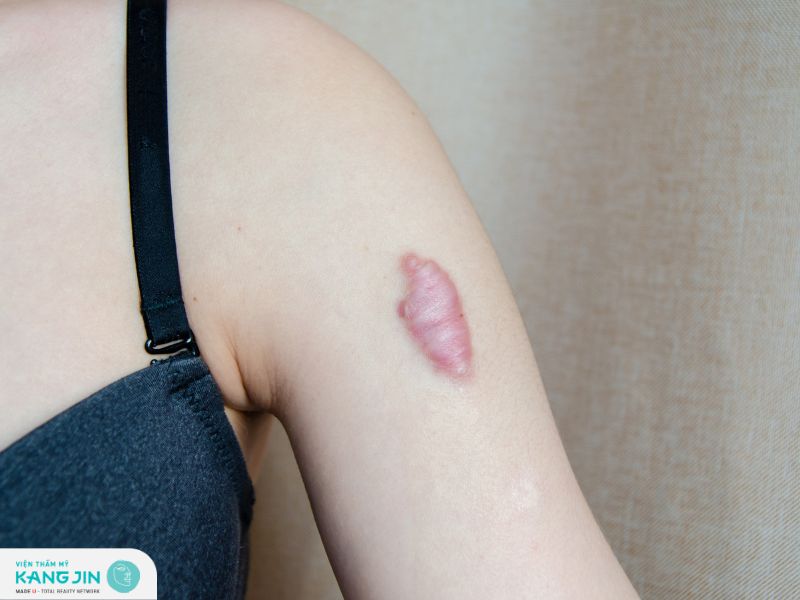 Những mẹo chữa sẹo lồi dân gian an toàn và hiệu quả tại nhà 