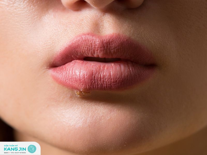 Dấu hiệu phun môi bị hỏng môi sưng tấy đau nhức mưng mủ hoặc nổi mụn nước