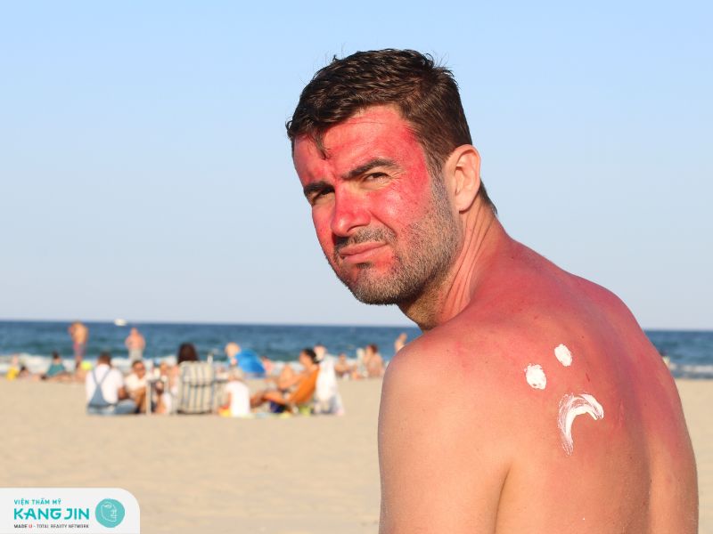 Tác động từ ánh nắng mặt trời cũng là nguyên nhân khiến da mặt sạm đen ở nam giới 