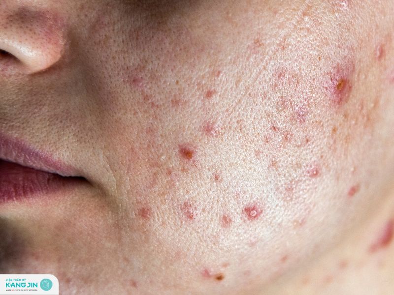 cách ngăn ngừa nhiễm trùng da