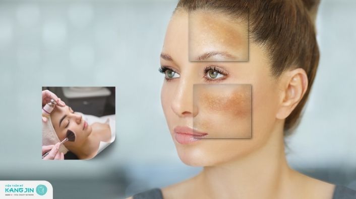 Peel da trị nám có được không? Ai nên và không nên áp dụng?