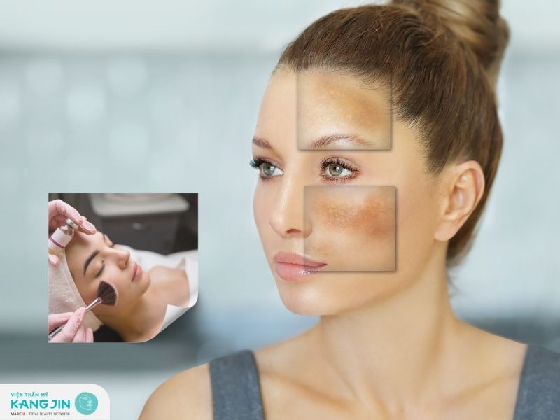 Peel da trị nám được không? Ai nên và không nên áp dụng?