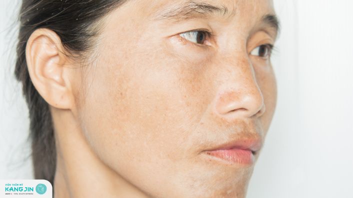 Rối loạn sắc tố da: Nguyên nhân, triệu chứng và cách điều trị