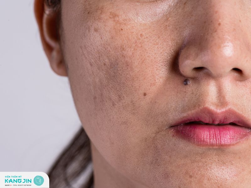 Sạm da là gì? Nguyên nhân và cách điều trị hiệu quả