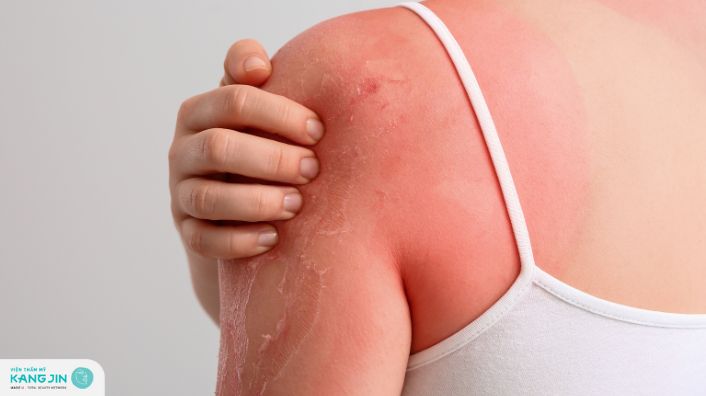 Nguyên nhân và cách khắc phục sau khi lột da body bị đỏ rát