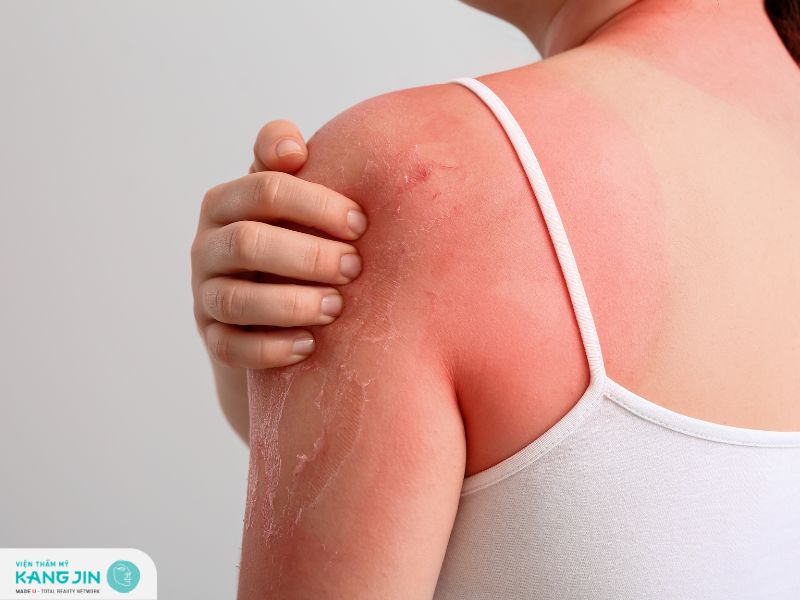Sau khi lột da body bị đỏ rát: Nguyên nhân và cách khắc phục hiệu quả