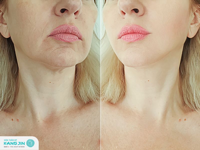 cách giúp da đỡ nhăn nheo