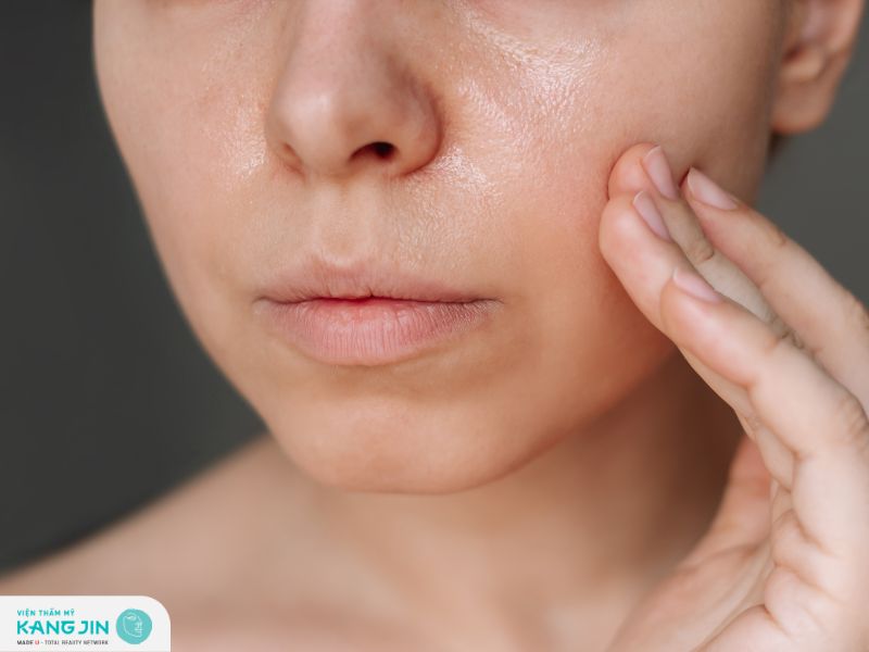 Da dầu có điều trị dứt điểm được không?