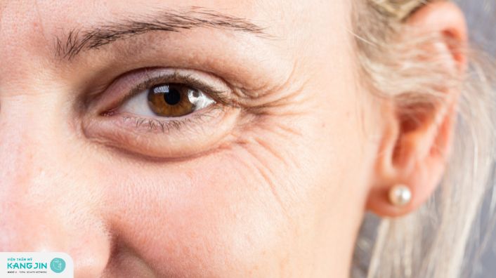 Vì sao có nếp nhăn dưới mắt? Các biện pháp ngăn ngừa