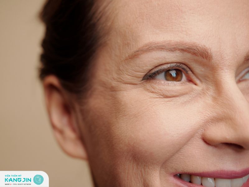 Góc giải đáp: Vì sao có nếp nhăn dưới mắt?