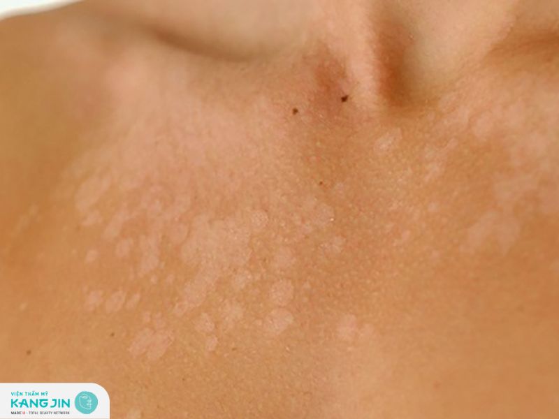 Nổi đốm trắng trên da là một trong những dấu hiệu của bệnh vảy phấn trắng