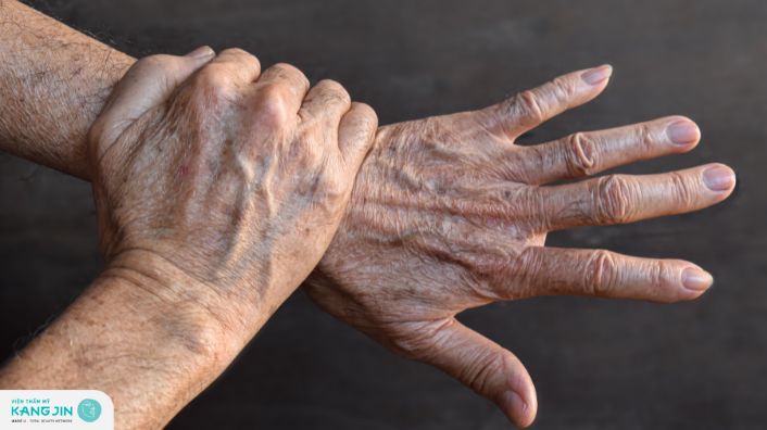 Tại sao xuất hiện vết thâm đen trên da tay? Cách loại bỏ