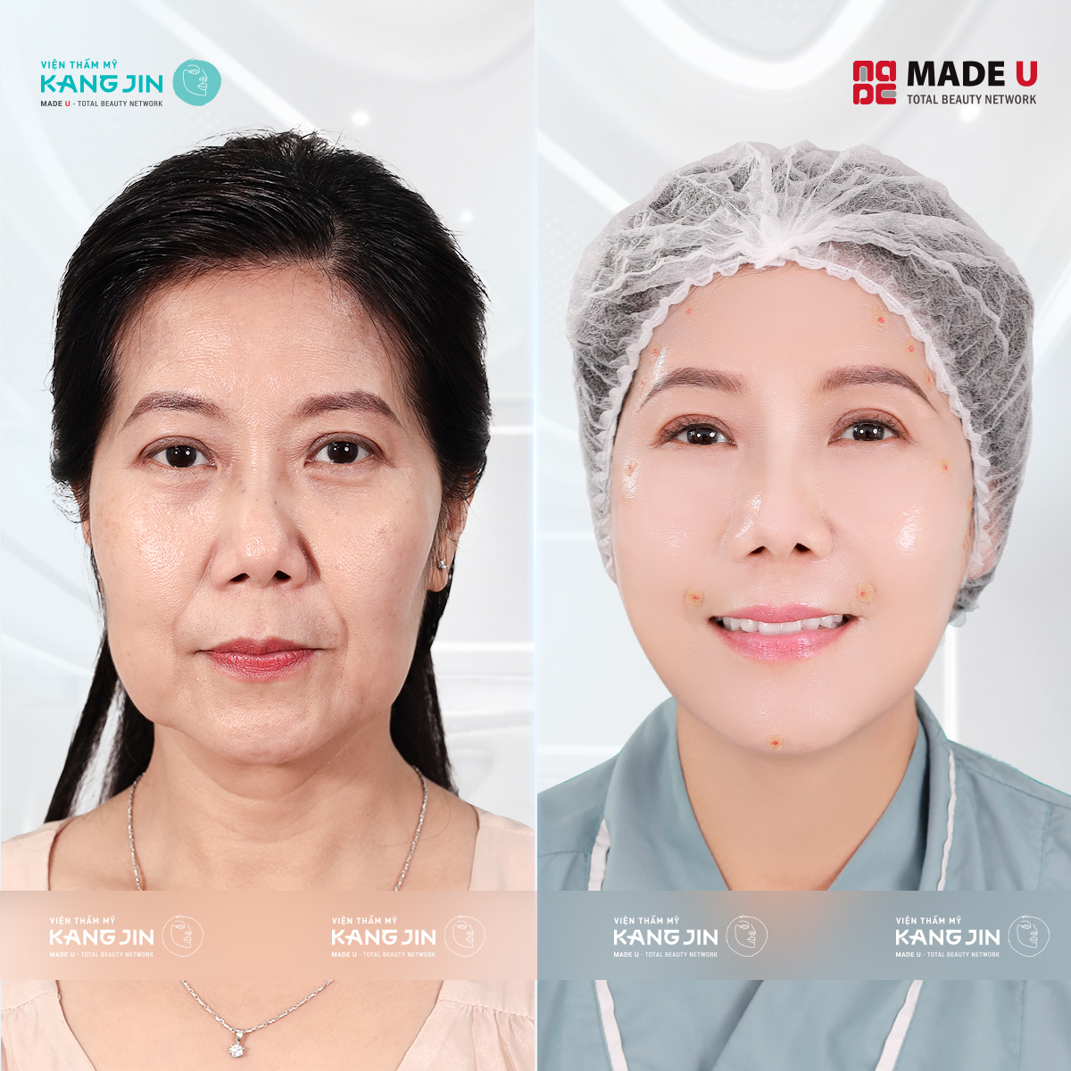 NSƯT Hương Tươi thực hiện liệu trình trẻ hóa, làm đầy hõm má tại VTM KangJin 