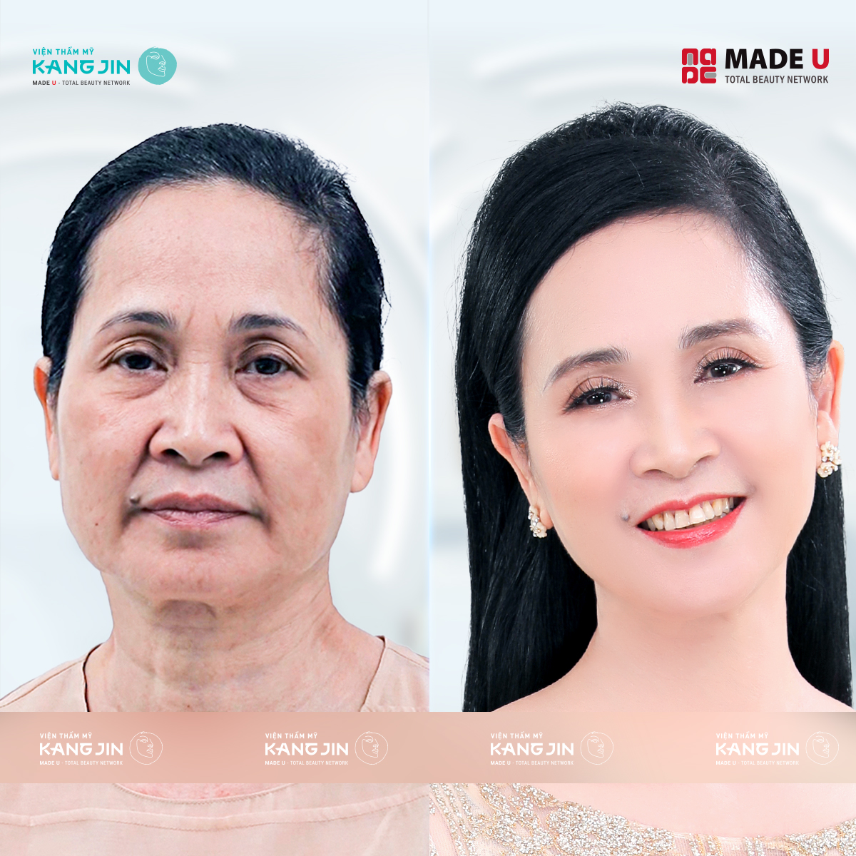 nghệ sĩ Hương Bông sau khi làm trẻ hóa da