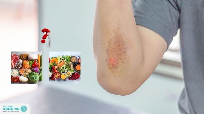 Bị trầy xước da không nên ăn gì để tránh bị sẹo? Top thực phẩm tốt cho vết thương