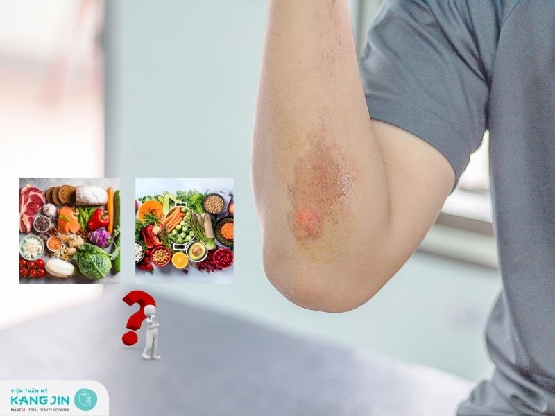 Bị trầy xước da không nên ăn gì để tránh bị sẹo
