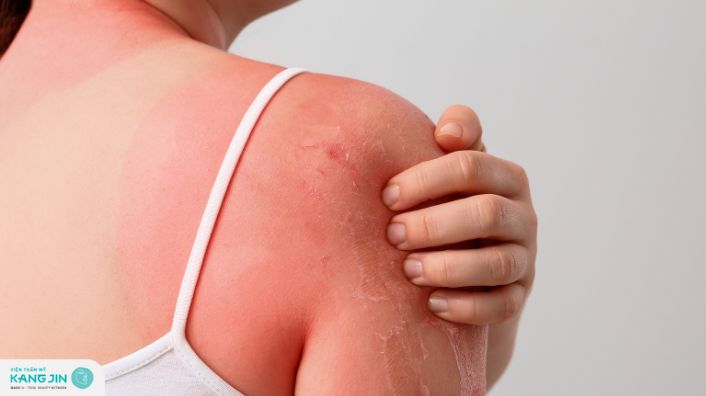 Các bệnh về da do ánh nắng mặt trời gây ra | 3 bệnh phổ biến