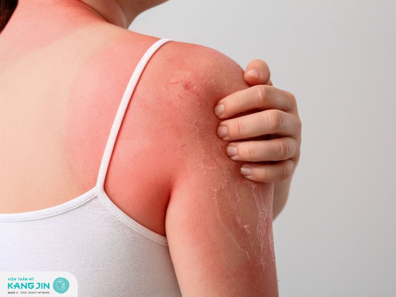 Các bệnh về da do ánh nắng mặt trời mà bạn nên biết 