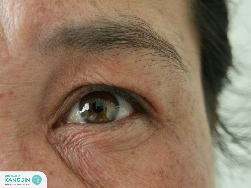 các phương pháp xóa nhăn vùng mắt hiệu quả hiện nay