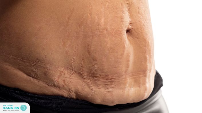 Hướng dẫn chăm sóc và cách trị rạn da đỏ khi tăng cân