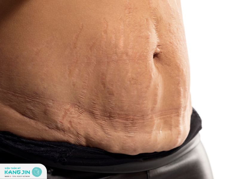 Tổng hợp các cách trị rạn da đỏ khi tăng cân hiệu quả 