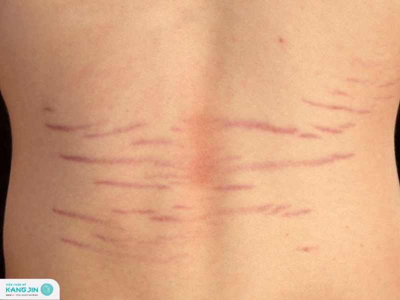 cách trị rạn da lưng