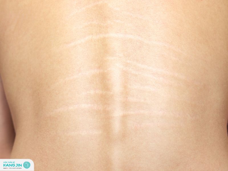 cách trị rạn da lưng
