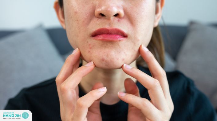 Chăm sóc da dầu mụn lỗ chân lông to: Bí quyết để có làn da mịn màng